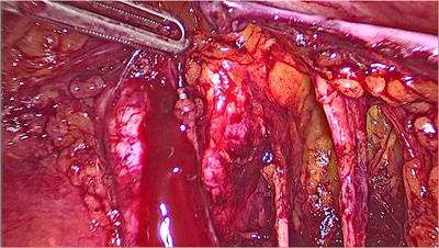 Left External Iliac Vein Injury During Laparoscopic Pelvic Lymphadenectomy for Early-Stage Ovarian Cancer: Our Experience and Review of Literature